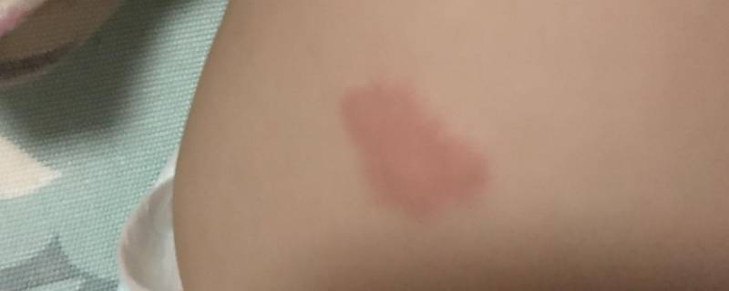胎记是这么形成的？